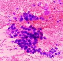 mikrofotografi av bra nål strävan cytologi av en lung- liten knöl som visar adenokarcinom, en typ av icke små cell carcinom. foto