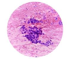 mikrofotografi av bra nål strävan cytologi av en lung- liten knöl som visar adenokarcinom, en typ av icke små cell carcinom. foto