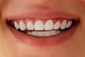 vit tänder närbild. dental blekning. foto