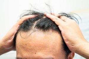 skallig på främre av huvud och Börja Nej förlust hår glabrous av mogna asiatisk företag smart aktiva kontor man. foto