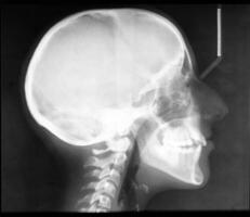 röntgenstråle av skalle foto