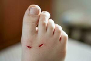 läkning av blödning sår på en barnets ben från nedskärningar foto