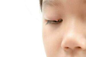 stänga upp av asiatisk liten flicka ett öga infektion isolerat foto