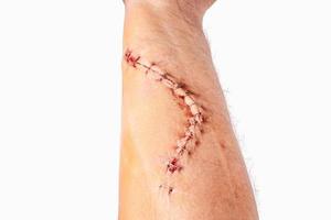 kirurgi sår fix med häftklammer på armen isolerad på vit bakgrund foto