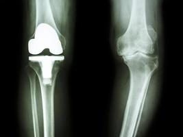 filma röntgen knä av artros knä patient och konstgjord led foto