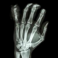 film röntgenstråle hand visa fraktur distalt pharange lillfinger foto