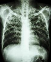 lung tuberkulosfilm bröst röntgen visar interstitiell infiltration både lunga på grund av mycobacterium tuberculosis infektion foto