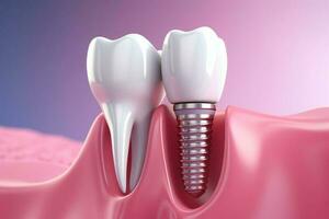 dental implantation, tänder med implantera skruva, illustration. ai genererad foto