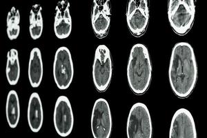 film ct-skanning av hjärnan visar ischemisk stroke och hemorragisk stroke foto