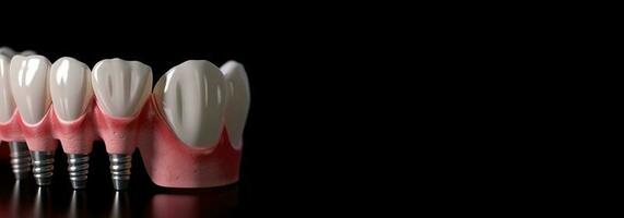 dental protes, tand implantera, attrapp på en svart bakgrund, isolera. ai genererad. foto