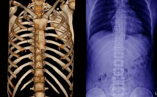 röntgen och ct skanna bröstkorg ryggrad foto