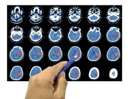stänga upp hand läkare punkt ct skanna av de nacke historia en 69-åring manlig presenteras med beräknad tomografi av de hjärna vänster talamisk blödning foto