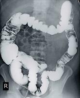 särskild undersökning barium lavemang en manlig 52 år gammal. foto