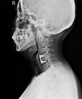 c-ryggrad röntgen spinal fikation av c5-6 kroppar Nej spinal förskjutning foto