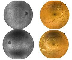 fundus fotografi galen näthinnan onormal isolerat på vit bakgrund. foto