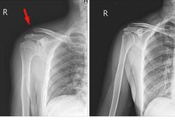 röntgen rätt axel foto