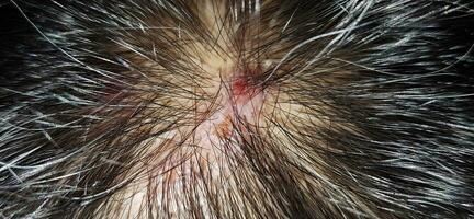skabb på de skalp, sår på de hårbotten eller lav planus follicularis capillitii, klia på de hårbotten foto