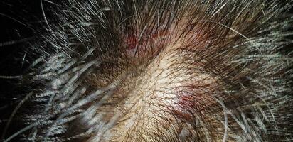 skabb på de skalp, sår på de hårbotten eller lav planus follicularis capillitii, klia på de hårbotten foto