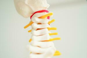 spinal nerv och ben, länd- ryggrad fördrivna herniated skiva fragment, modell för behandling medicinsk i de ortopedisk avdelning. foto