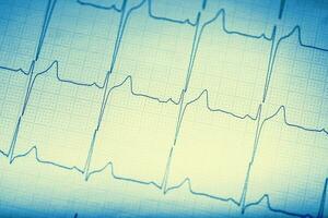 ekg graf.elektrokardiogram ekg ecg. foto