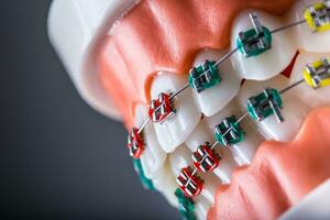 närbild av en ortodontisk modell käftar och tänder med tandställning foto