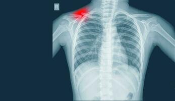 röntgen bild av bröst för en medicinsk diagnos visningar som visar fraktur mitten kavikel på röd märke, medicinsk bild begrepp. och coppy Plats. foto