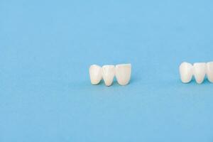 tänder implantera och krona installation bearbeta delar isolerat på en blå bakgrund. medicinskt exakt 3d modell. foto