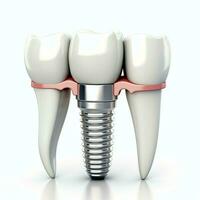 stänga upp av en dental tand implantera eller friska mänsklig tänder. vit emalj och dental implantat kirurgi begrepp förbi ai genererad foto