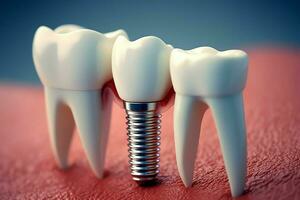 stänga upp av en dental tand implantera eller friska mänsklig tänder. vit emalj och dental implantat kirurgi begrepp förbi ai genererad foto