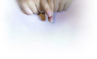 finger svullen med inflammation på grund av till nagel rev infektion foto