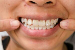 närbild av en leende kvinnas tänder avslöjande vit fläckar och plack på de tand yta. oral vård och dental begrepp. foto