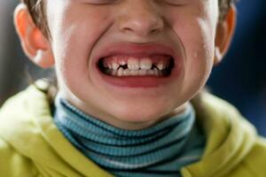 hål i plats av en bebis tand fallen ut. barn rop fallen tand. teardrop på kind. växande permanent tänder. foto