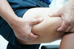 asiatisk kvinna med celluliter på ben hud fett, övervikt problem. foto