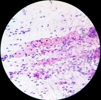 mikrofotografi av papper smeta som visar inflammatorisk smeta med hpv relaterad ändringar. cervical cancer. scc foto