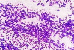 usg guidad fna cytologi av lever sol som visar icke hodgkin lymfom. metastatisk carcinom foto