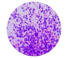 usg guidad fna cytologi av lever sol som visar icke hodgkin lymfom. metastatisk carcinom foto