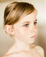 närbild porträtt av liten flicka med vattkoppor, vattkoppor virus eller vesikulär utslag foto