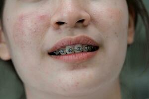 tandställning i Tonårs flicka mun till behandla och skönhet för öka förtroende och Bra personlighet. foto