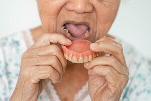 asiatisk äldre kvinna patient innehav till använda sig av tandprotes, friska stark medicinsk begrepp. foto
