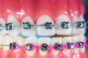 de tandställning är placerad på de tänder i de artificiell käke. makro fotografi foto
