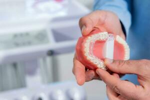 närbild. de läkare sätter transparent inriktare på de tänder av de artificiell käke foto