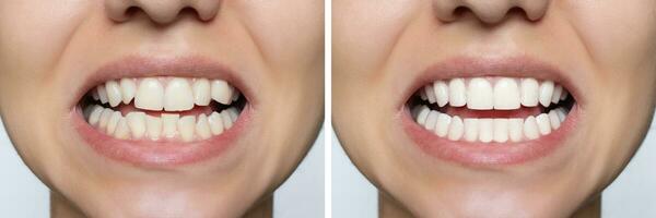 ung kvinnas leende innan och efter tänder uträtning. idealisk, skön form av tänder på de övre och lägre käke efter montera faner eller tandställning. blekning. dental klinik patient. foto