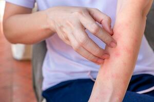 stänga upp av kvinna ärm repa de klia förbi hand på Hem, klåda på grund av till utslag, svamp, allergi, dermatologisk sjukdom, torr hud. sjukvård och medicinsk begrepp. foto