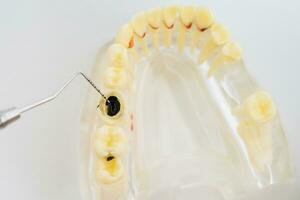 läkare ortodontist visar de instrument på karies i de tänder foto