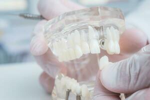 de ortodontist innehar en modell av tänder med implantat i hans hand och visar på vilket sätt till Föra in de tand. stänga upp. makro foto