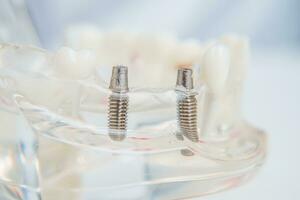 en modell av tänder med implantat lögner på en tabell foto