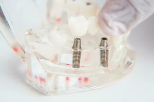 ortodontist visar på vilket sätt till Föra in de implantera. makro foto