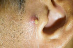 pus kommande från nodulär cystisk acne i främre av de man öra foto