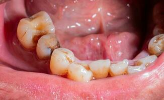 tand förfall, bruten tänder, oral hälsa fattig dental hälsa. oral hälsa problem. lösa, gul tänder, plack och tartar på de kant av de tandkött foto