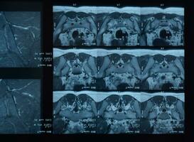 mri sacroiliac artikulation. studie av ankyloserande spondyloartrit patient. foto